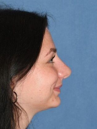 Rhinoplasty Transformative rhinoplasty at 2 years - After