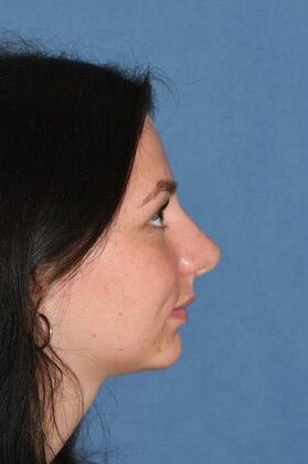 Rhinoplasty: Transformative rhinoplasty at 2 years - After
