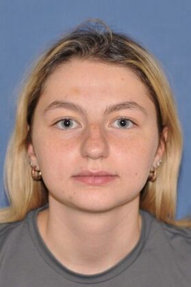 Rhinoplasty: Transformative rhinoplasty at 2 years - Before