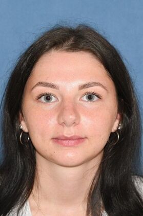 Rhinoplasty: Transformative rhinoplasty at 2 years - After