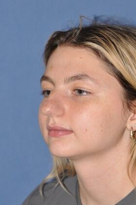 Rhinoplasty: Transformative rhinoplasty at 2 years - Before