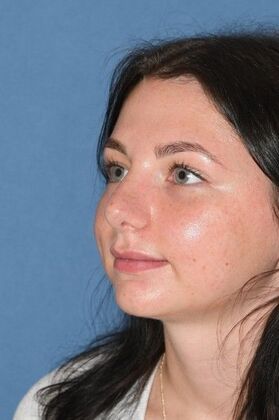 Rhinoplasty: Transformative rhinoplasty at 2 years - After