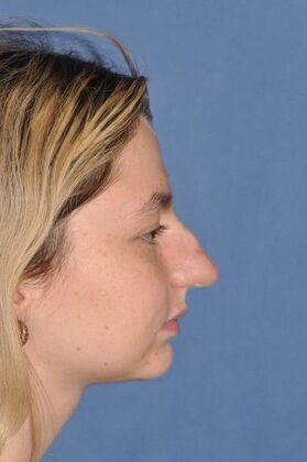 Rhinoplasty: Transformative rhinoplasty at 2 years - Before