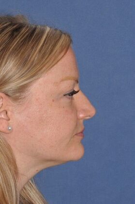 Rhinoplasty: Rotate the tip and shave the bump! - Before