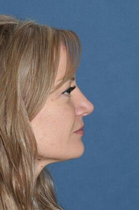 Rhinoplasty: Rotate the tip and shave the bump! - After