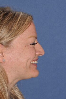 Rhinoplasty Rotate the tip and shave the bump! - Before