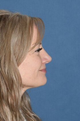 Rhinoplasty Rotate the tip and shave the bump! - After