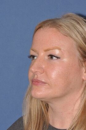 Rhinoplasty: Rotate the tip and shave the bump! - Before