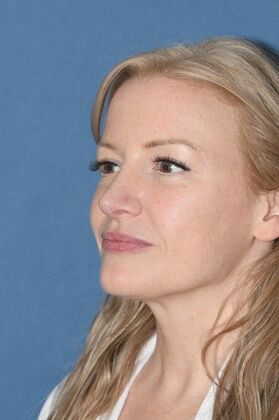 Rhinoplasty: Rotate the tip and shave the bump! - After