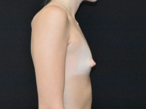 Breast Augmentation: Case 32 - Before