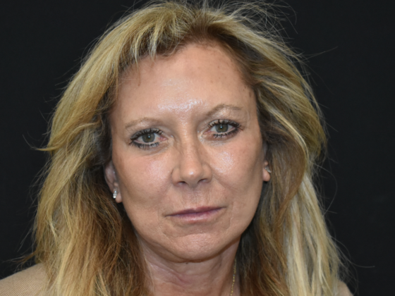 Facelift Case 1 - After