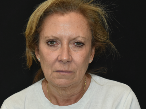 Facelift Case 1 - Before