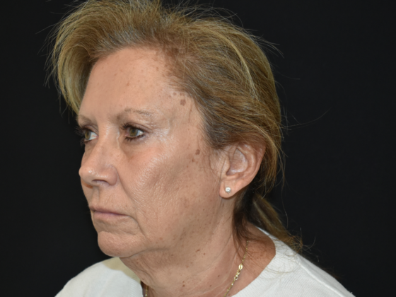 Facelift: Case 1 - Before