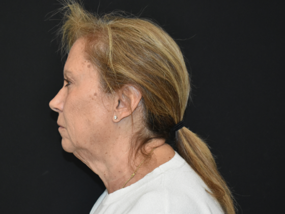 Facelift: Case 1 - Before