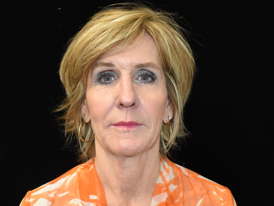 Facelift Case 2 - Before
