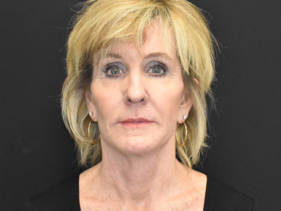 Facelift Case 2 - After