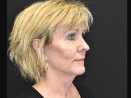 Facelift: Case 2 - After