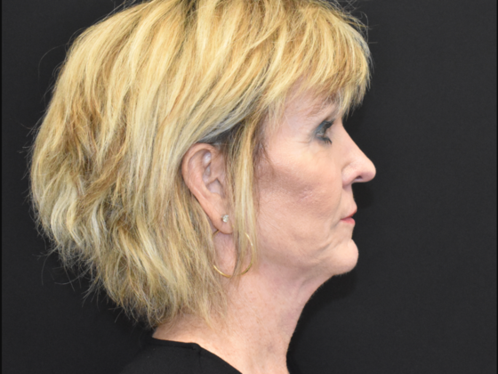 Facelift: Case 2 - After