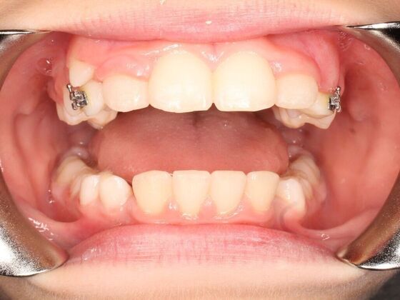 Orthodontics : Valor - Airway Expansion - After