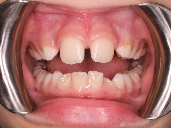 Orthodontics : Valor - Airway Expansion - Before