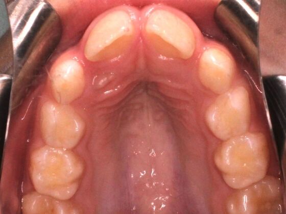 Orthodontics : Valor - Airway Expansion - Before