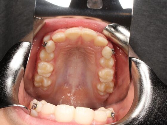 Orthodontics : Valor - Airway Expansion - After
