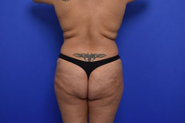 Brazilian Butt Lift (Augmentation) Case 13 - Before