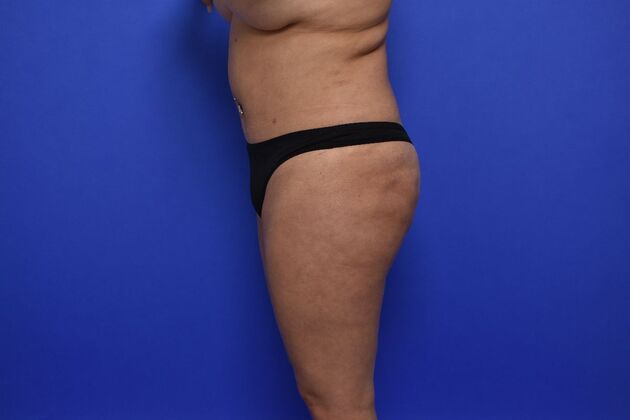 Brazilian Butt Lift (Augmentation): Case 13 - Before