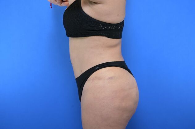 Tummy Tuck with LipoContouring: Case 29 - Tummy tuck revision with Lipo and BBL - After