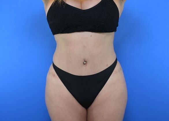 Tummy Tuck with LipoContouring: Case 29 - Tummy tuck revision with Lipo and BBL - After