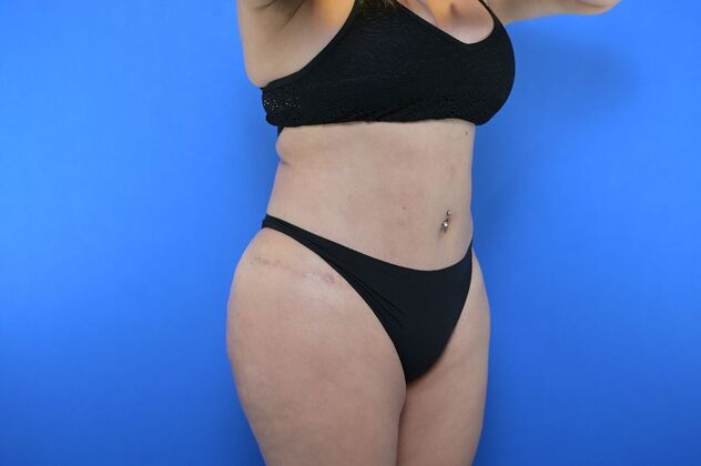 Tummy Tuck with LipoContouring: Case 29 - Tummy tuck revision with Lipo and BBL - After
