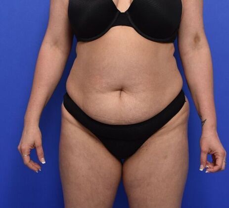 Tummy Tuck with LipoContouring: Case 30 Mommy makeover - Before
