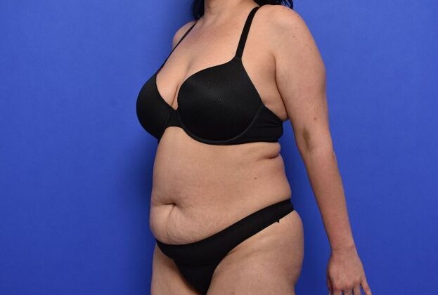 Tummy Tuck with LipoContouring: Case 30 Mommy makeover - Before