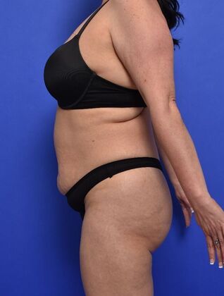 Tummy Tuck with LipoContouring: Case 30 Mommy makeover - Before