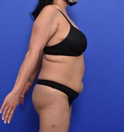 Tummy Tuck with LipoContouring: Case 30 Mommy makeover - Before