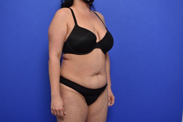 Tummy Tuck with LipoContouring: Case 30 Mommy makeover - Before