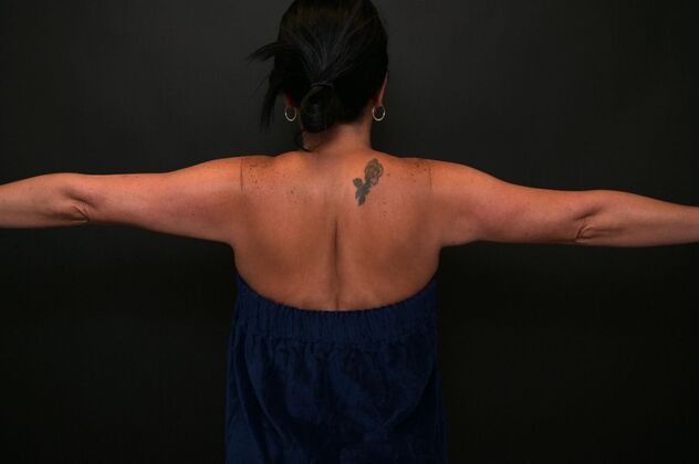 No-incision Arm Lift (lipo and bodytite) Case 5 - After