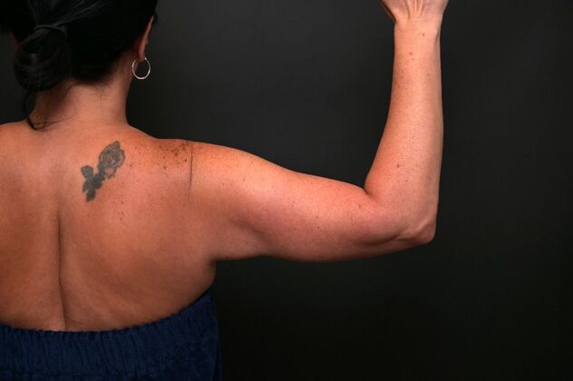No-incision Arm Lift (lipo and bodytite): Case 5 - After