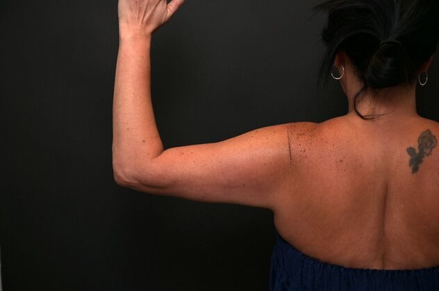 No-incision Arm Lift (lipo and bodytite): Case 5 - After
