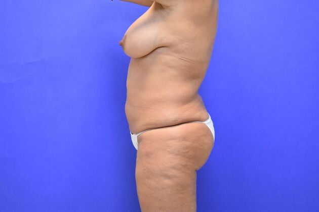 Tummy Tuck with LipoContouring: Case 31 360 lipo, lipocontouring, TT - Before