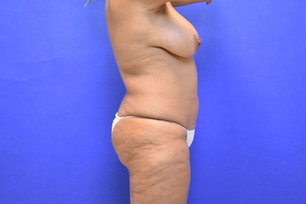 Tummy Tuck with LipoContouring: Case 31 360 lipo, lipocontouring, TT - Before
