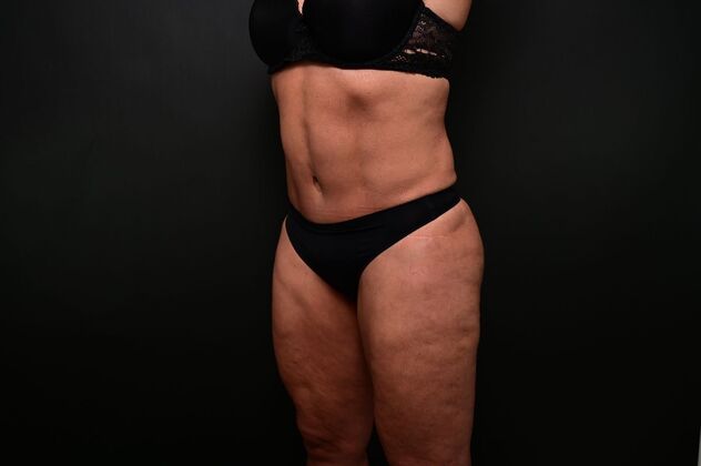 Tummy Tuck with LipoContouring: Case 31 360 lipo, lipocontouring, TT - After