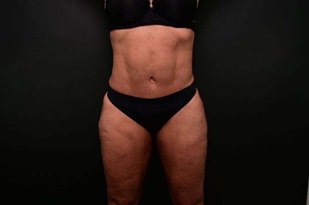 Tummy Tuck with LipoContouring: Case 31 360 lipo, lipocontouring, TT - After
