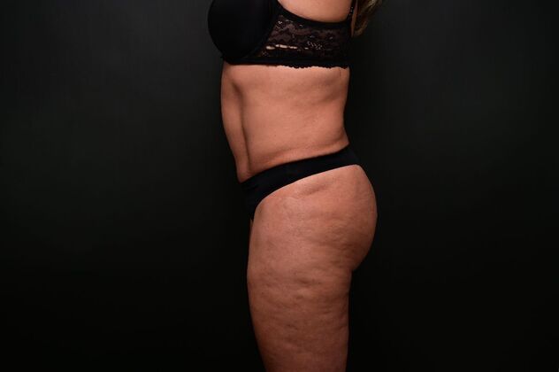 Tummy Tuck with LipoContouring: Case 31 360 lipo, lipocontouring, TT - After
