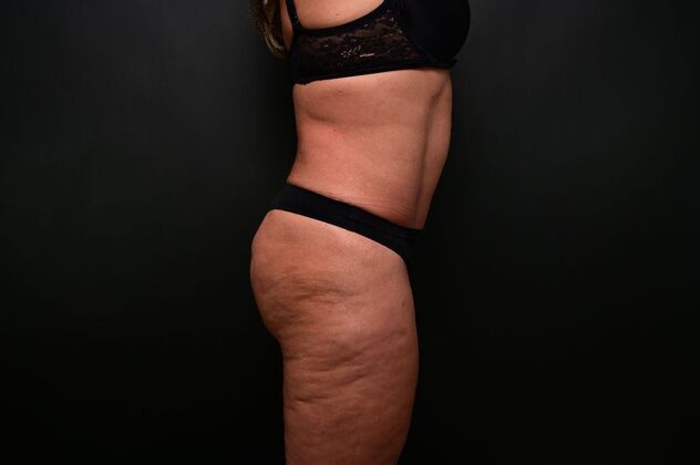 Tummy Tuck with LipoContouring: Case 31 360 lipo, lipocontouring, TT - After