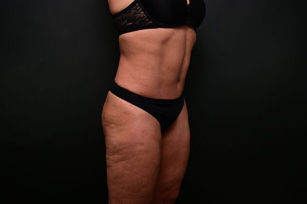 Tummy Tuck with LipoContouring: Case 31 360 lipo, lipocontouring, TT - After
