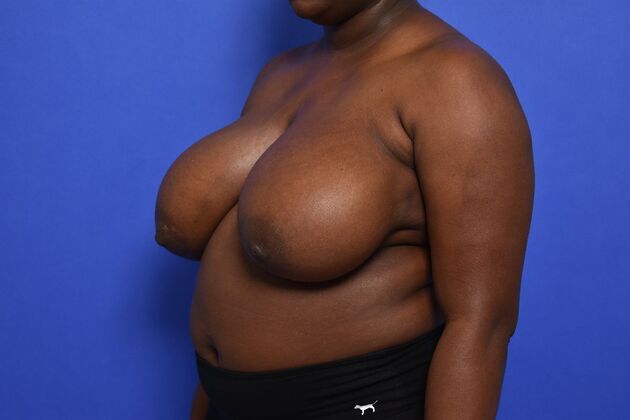 Breast Reduction: Case 25 - Before