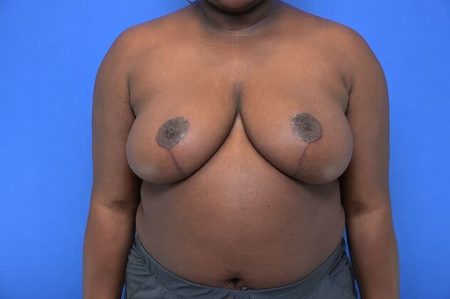 Breast Reduction Case 25 - After