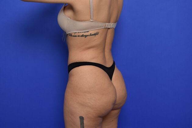 Brazilian Butt Lift (Augmentation): Case 14 - Before