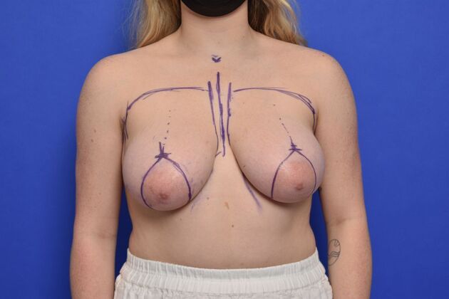 Breast Lift Case 16 - Before